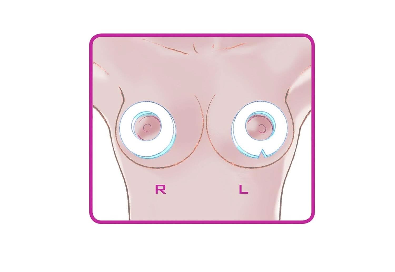 ELANEE Brust-Ringe, Schutz Der Brustwarze Bh-Kontakt Durch Hohllagerung, Ideal Bei Wunden, Entzündeten Brustwarzen Durch Stillen, 10 Stück (222-00) Tilbehør Mad og Amning Bebe Naty Shop